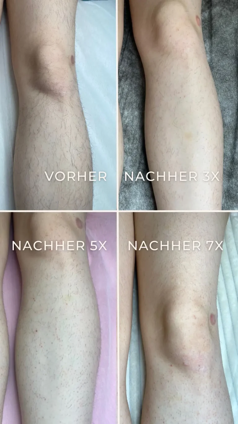 Dauerhafte Haarentfernung Mönchengladbach 13 Elektroepilation Beine – Vorher und Nachher 5x