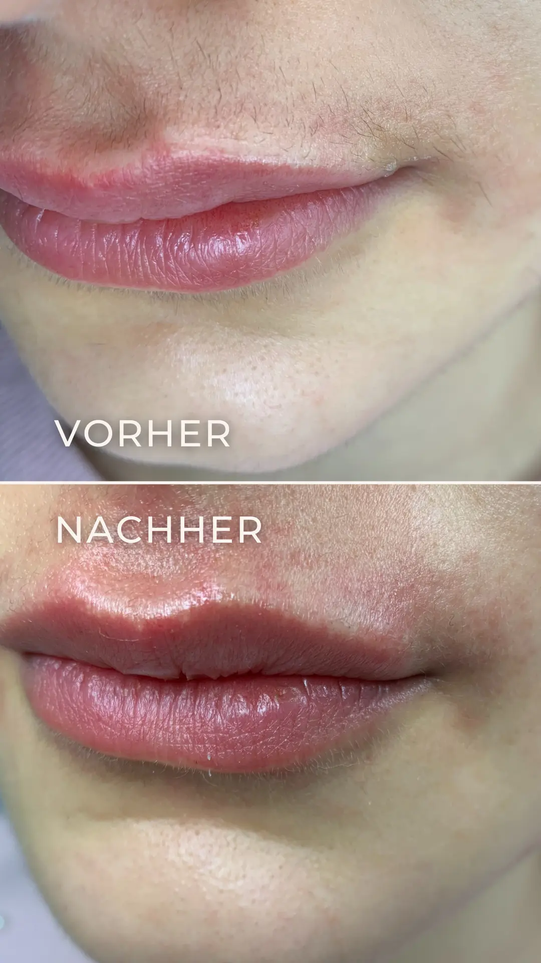 Elektroepilation Mönchengladbach 6 Vorher-Nachher-Ergebnis der Elektroepilation der Oberlippe