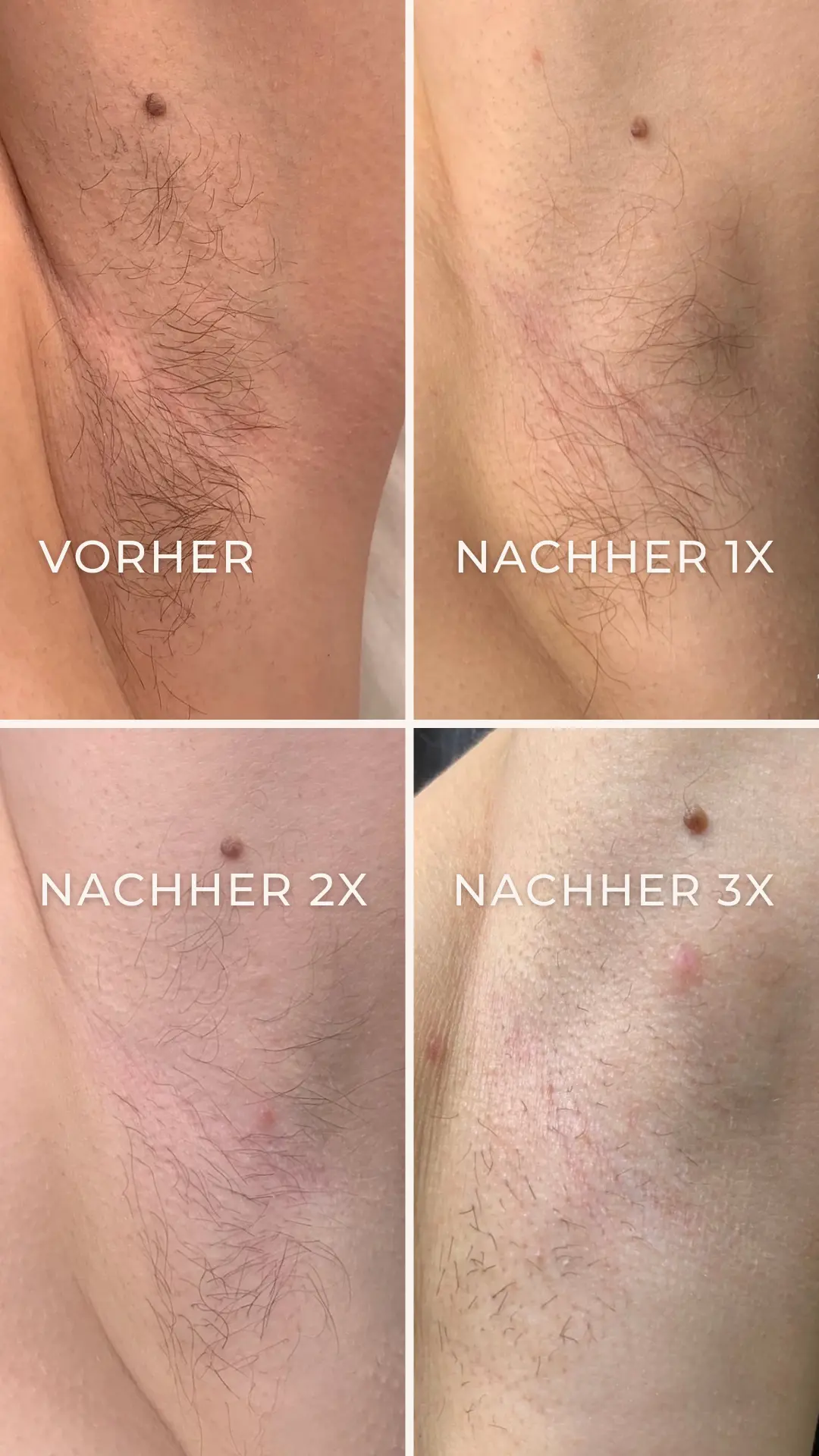Elektroepilation Mönchengladbach 5 Vorher-Nachher-Ergebnis der Elektroepilation nach 1, 2 und 4 Behandlungen