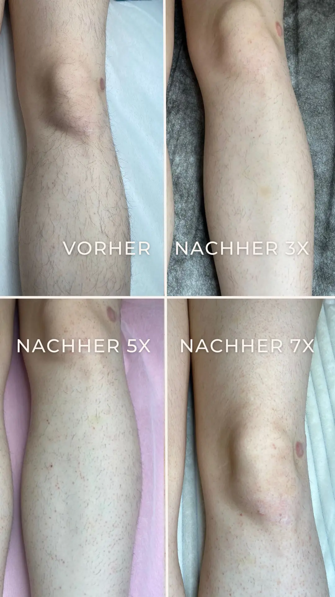 Elektroepilation Mönchengladbach 7 Vorher-Nachher-Ergebnis der Elektroepilation an den Beinen