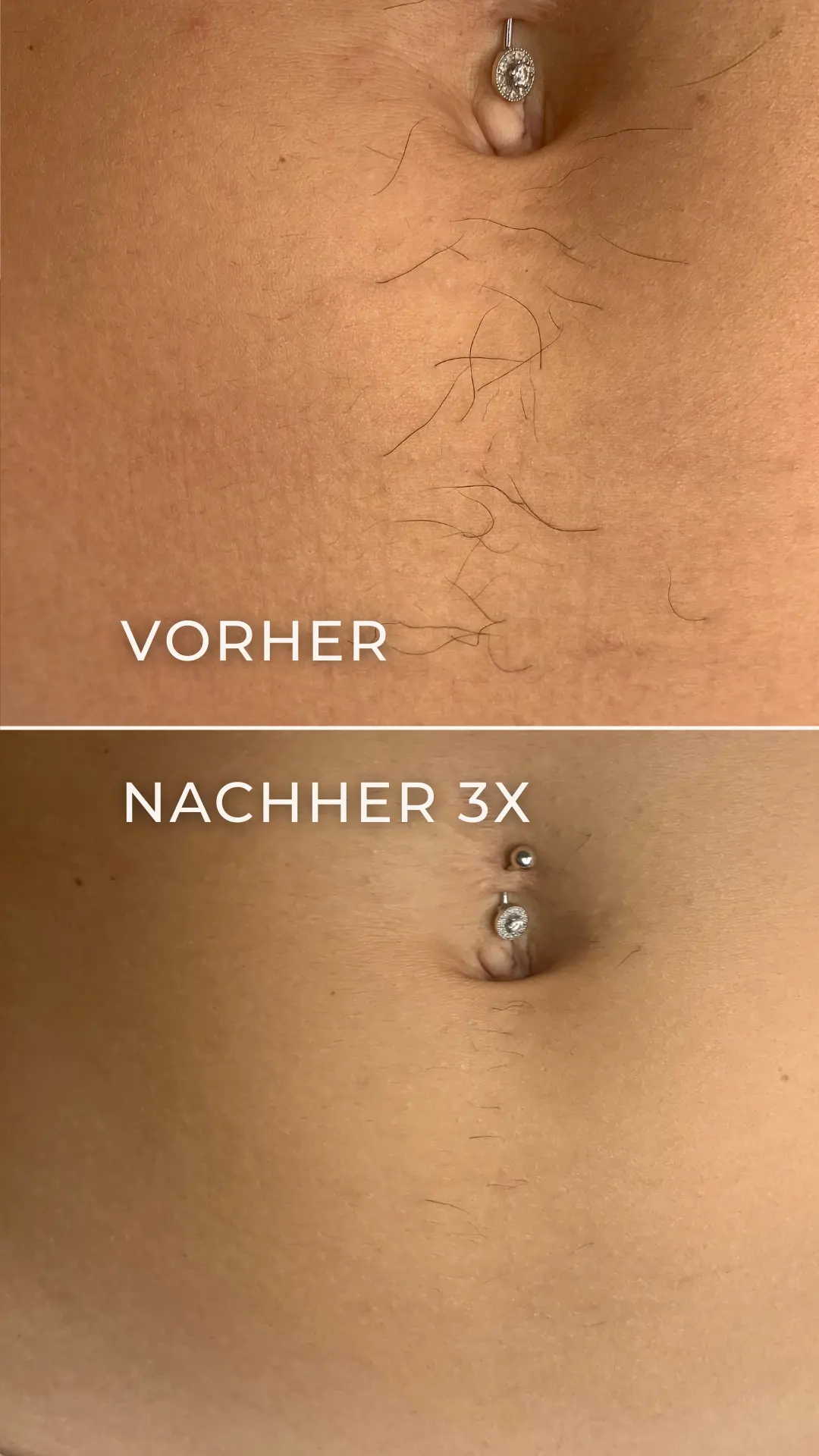 Elektroepilation Mönchengladbach 4 Vorher-Nachher-Ergebnis der Elektroepilation am Bauch nach 3 Behandlungen.