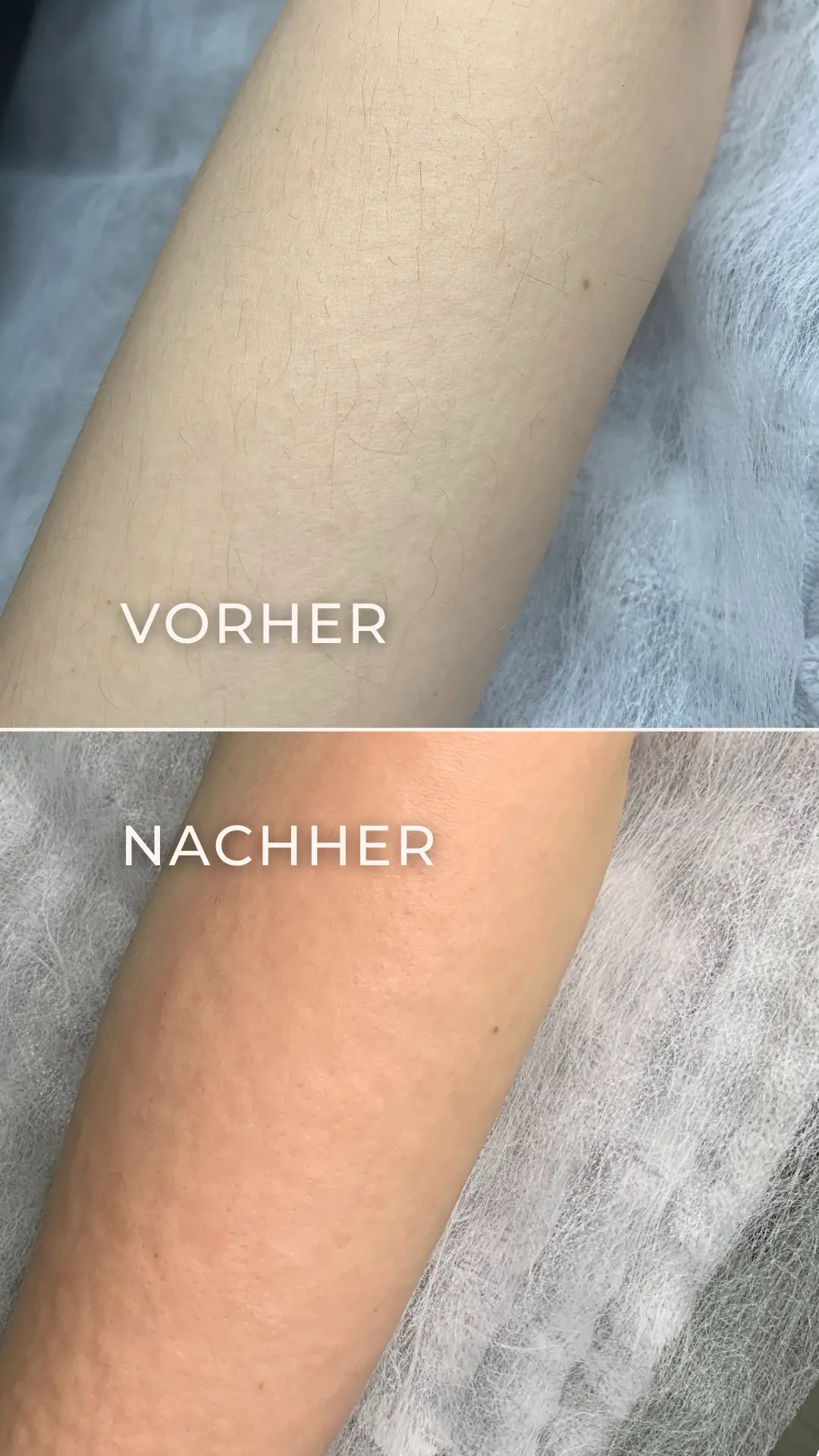 Elektroepilation Mönchengladbach 8 Vorher-Nachher-Ergebnis der Elektroepilation am Unterarm