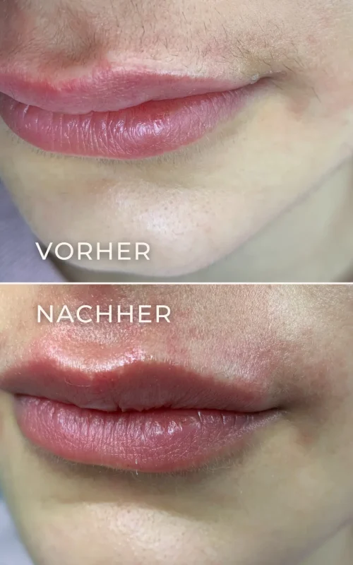 Vorher-Nachher-Ergebnis der Elektroepilation der Oberlippe