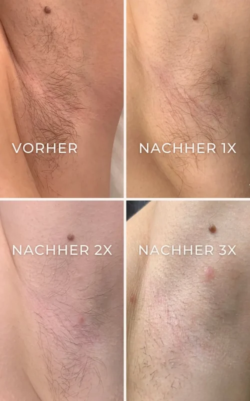 Vorher-Nachher-Ergebnis der Elektroepilation nach 1, 2 und 4 Behandlungen