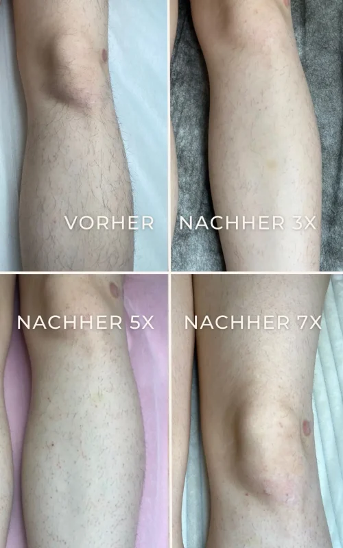 Vorher-Nachher-Ergebnis der Elektroepilation an den Beinen