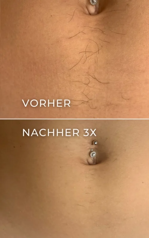 Vorher-Nachher-Ergebnis der Elektroepilation am Bauch nach 3 Behandlungen.