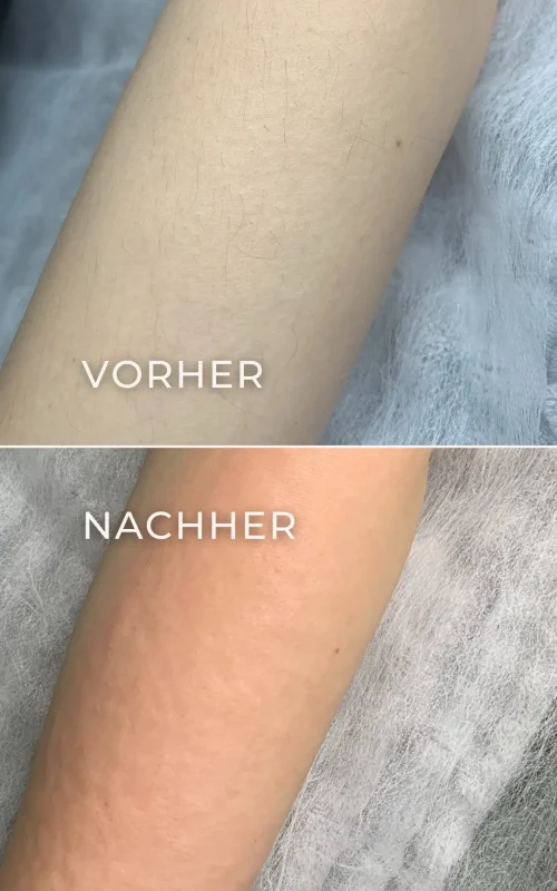 Vorher-Nachher-Ergebnis der Elektroepilation am Unterarm